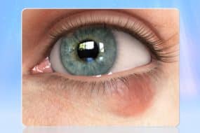 chalazion overview