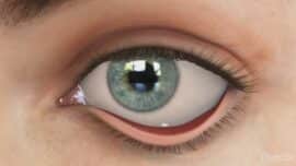 ectropion eye