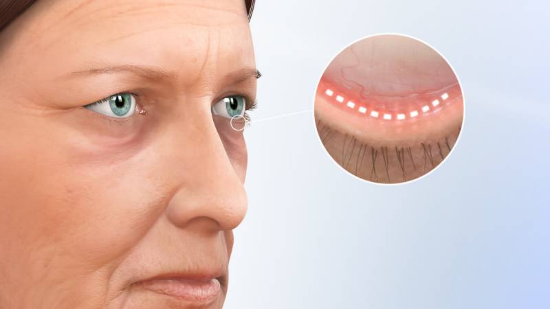 eyelid lift surgery