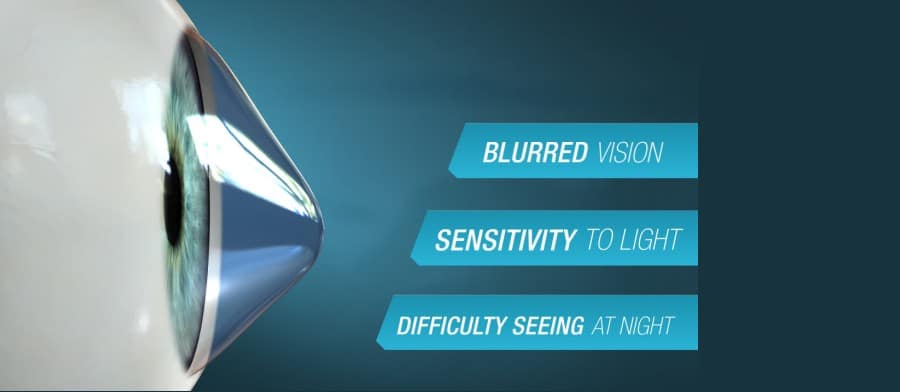 Keratoconus Diagram