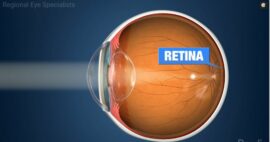 refractive errors regional eye optical